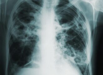 World Tuberculosis (TB) Day, March 24th