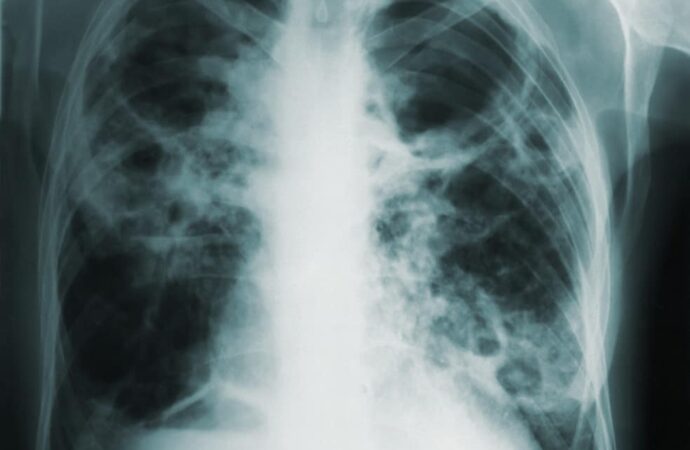 World Tuberculosis (TB) Day, March 24th